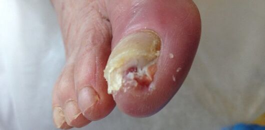 A rezervoár és a dermatofit gomba forrása beteg ember